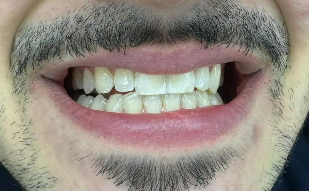 After whitening treatment at Bhati Dental Clinic